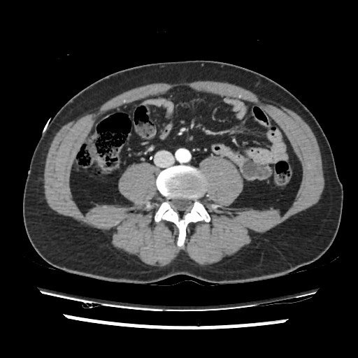 File:Adrenal gland trauma (Radiopaedia 81351-95078 Axial Dual bolus trauma C+ 87).jpg