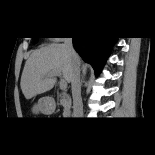 File:Adrenal gland trauma (Radiopaedia 81351-95079 Sagittal non-contrast 43).jpg