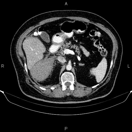 Adrenal hemorrhage (Radiopaedia 62622-70916 Axial C+ portal venous phase 64).jpg