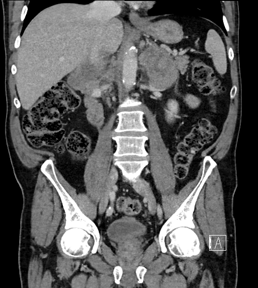 Adrenal lymphoma (Radiopaedia 73730-84529 Coronal C+ portal venous phase 44).jpg