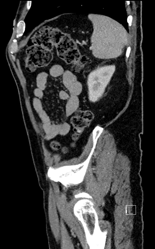Adrenal lymphoma (Radiopaedia 73730-84529 Sagittal C+ portal venous phase 91).jpg