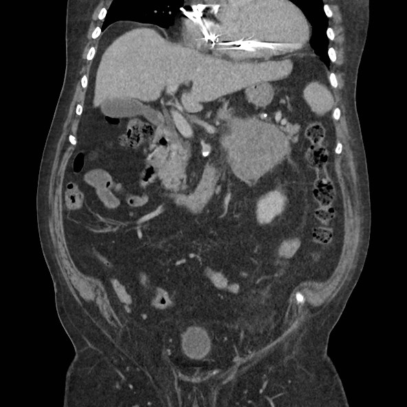 Adrenal lymphoma (Radiopaedia 84145-99415 Coronal C+ portal venous phase 34).jpg