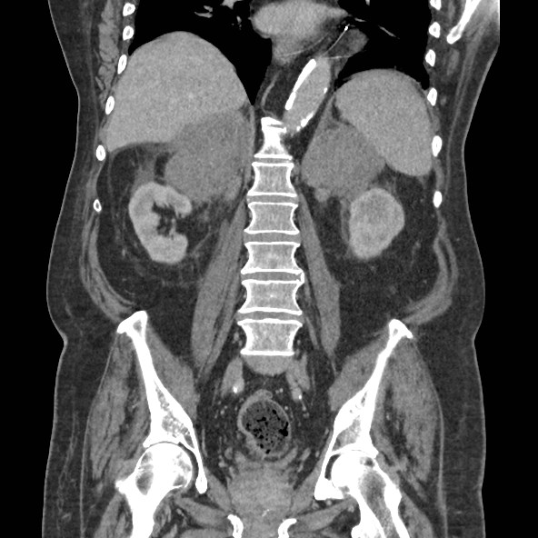 Adrenal lymphoma (Radiopaedia 84145-99415 Coronal C+ portal venous phase 57).jpg