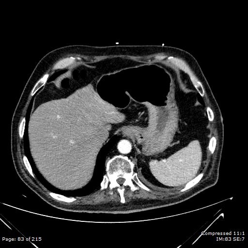 Adrenal metastasis (Radiopaedia 78425-91079 Axial C+ arterial phase 13).jpg