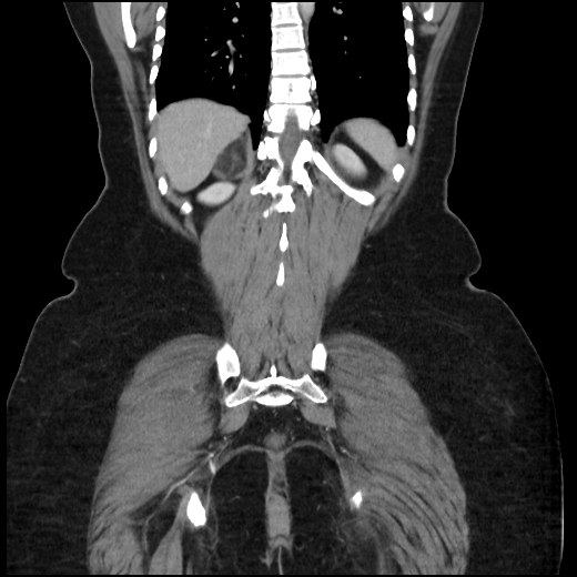 Adrenal myelolipoma (Radiopaedia 43401-46759 Axial non-contrast 40).jpg