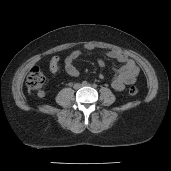 Adrenal myelolipoma (Radiopaedia 43401-46759 Axial non-contrast 53).jpg