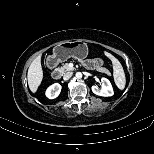 Adrenal myelolipoma (Radiopaedia 82742-96986 Axial renal cortical phase 68).jpg