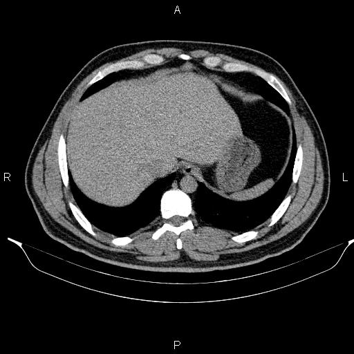 Adrenal myelolipoma (Radiopaedia 84321-99619 Axial non-contrast 17).jpg