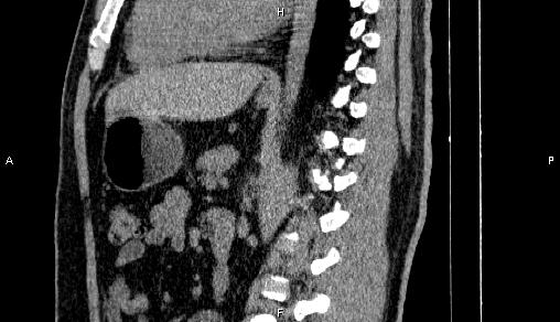 Adrenal myelolipoma (Radiopaedia 84321-99619 Sagittal non-contrast 62).jpg