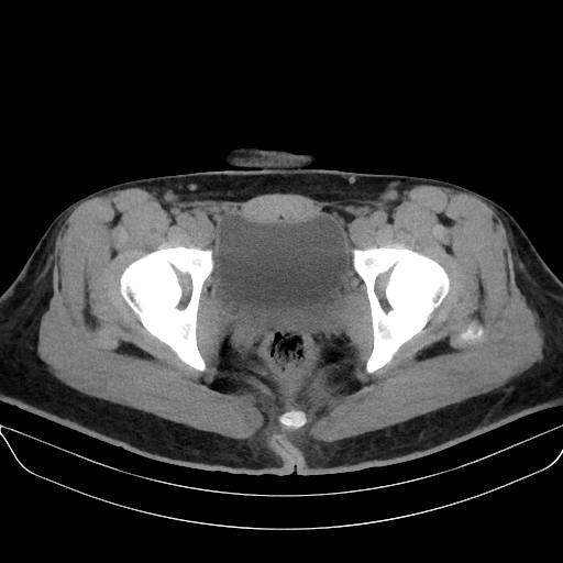 Adrenal myelolipoma - bilateral (Radiopaedia 74805-85810 Axial non-contrast 79).jpg