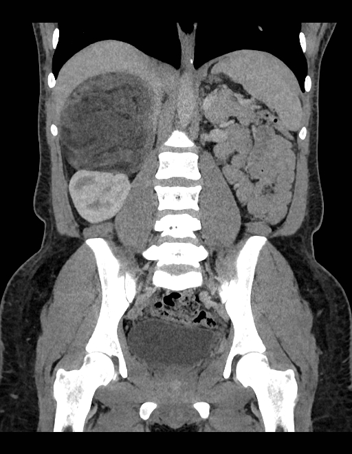 Adrenal myelolipoma - bilateral (Radiopaedia 74805-85810 Coronal C+ portal venous phase 133).jpg