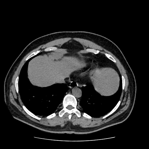 Adrenal myelolipoma and beaver tail liver (Radiopaedia 86201-102193 Axial non-contrast 36).jpg