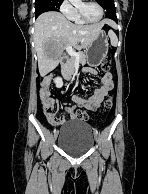 Adrenocortical carcinoma (Radiopaedia 87281-103569 Coronal C+ portal venous phase 14).jpg