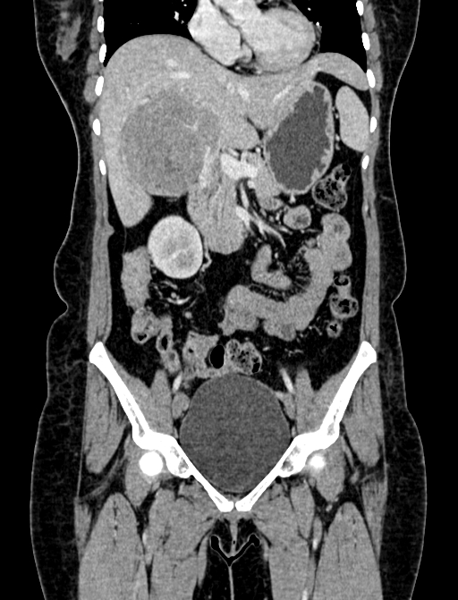 Adrenocortical carcinoma (Radiopaedia 87281-103569 Coronal C+ portal venous phase 26).jpg