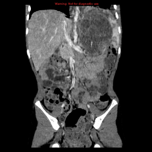 File:Adrenocortical carcinoma (Radiopaedia 9449-10131 Coronal C+ portal venous phase 7).jpg