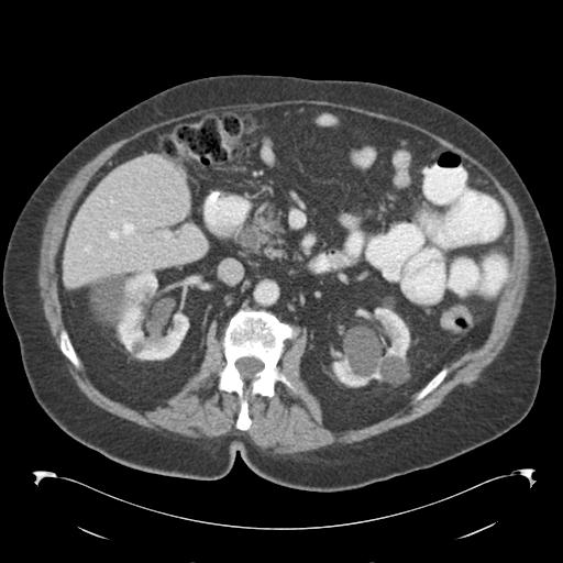 Adult ileal intussusception with secondary obstruction (Radiopaedia 30395-31051 Axial C+ portal venous phase 30).jpg