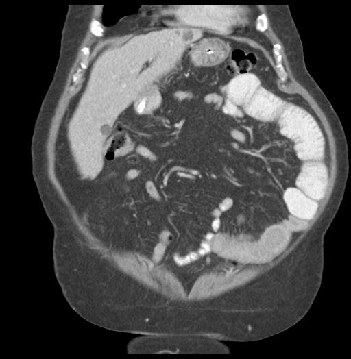 Adult ileal intussusception with secondary obstruction (Radiopaedia 30395-31051 Coronal C+ portal venous phase 18).jpg