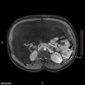 File:Aggressive angiomyxoma (Radiopaedia 73343-84093 Axial T1 C+ fat sat 168).jpg
