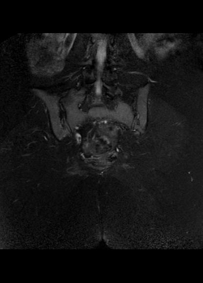 File:Aggressive angiomyxoma of the pelvis and perineum (Radiopaedia 59162-66479 Coronal T2 fat sat 24).jpg