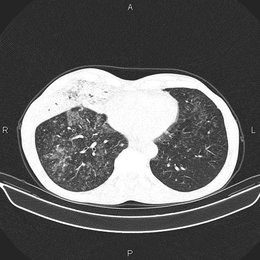 Air bronchogram in pneumonia (Radiopaedia 85719-101512 Axial lung window 49).jpg