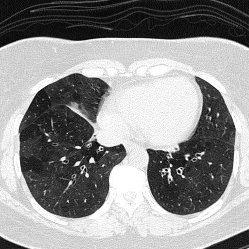 File:Air trapping in small airway disease (Radiopaedia 61685-69694 Axial lung window 125).jpg