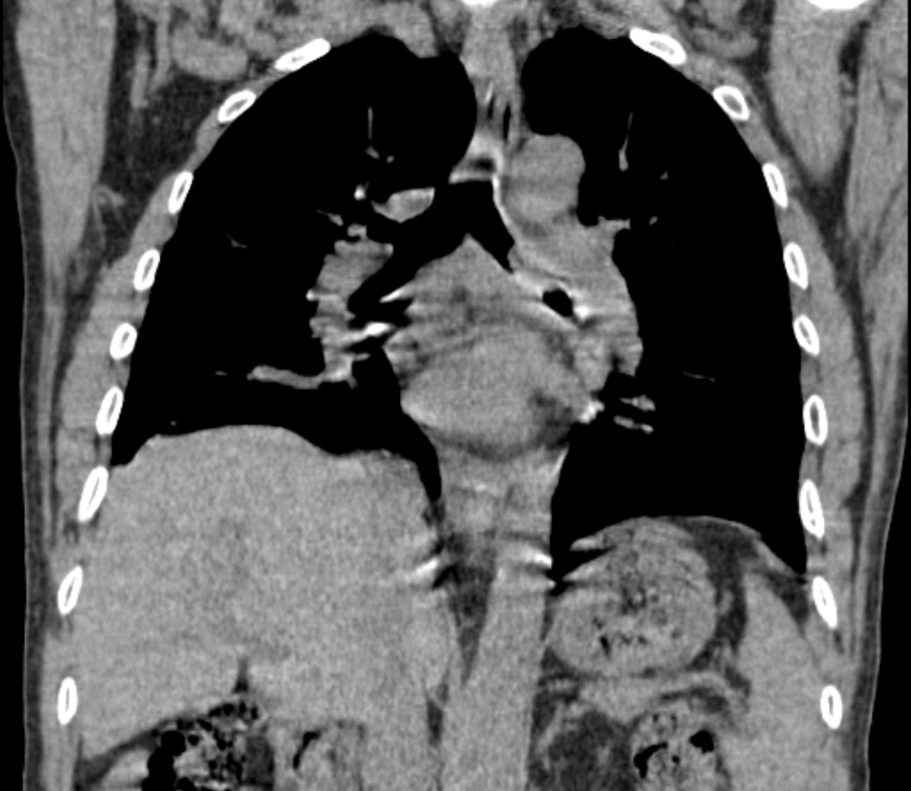 Airway foreign body in adult (Radiopaedia 85907-101779 Coronal liver window 153).jpg