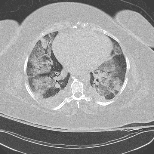 All trans retinoic acid (ATRA) syndrome (Radiopaedia 38212-40229 Axial lung window 35).jpg