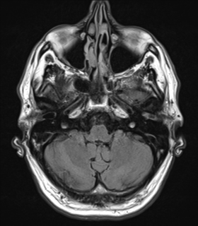 File:Alzheimer's disease- with Gerstmann syndrome and dressing apraxia (Radiopaedia 54882-61150 Axial FLAIR 5).png