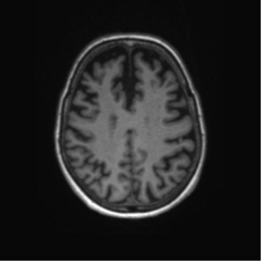 File:Alzheimer's disease (Radiopaedia 42658-45802 Axial T1 52).png