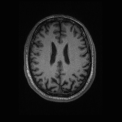 Alzheimer disease - probable (Radiopaedia 35334-36837 Axial T1 49).png