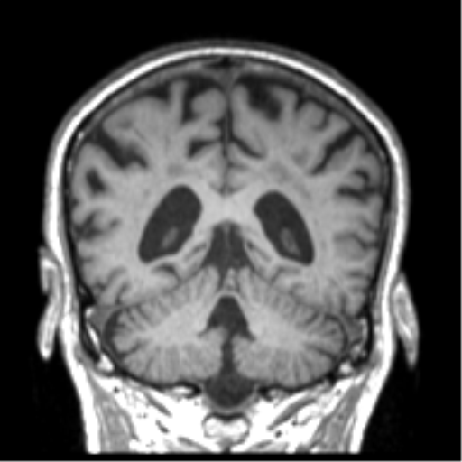 File:Alzheimer disease and cerebral amyloid angiopathy (Radiopaedia 64234-73011 Coronal T1 18).png