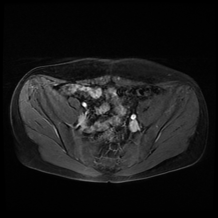 Ambiguous genitalia (Radiopaedia 69686-79643 Axial T1 C+ fat sat 13).jpg