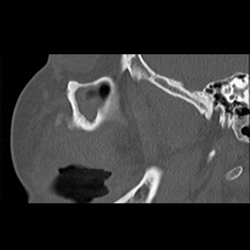 File:Ameloblastic fibro-odontoma (Radiopaedia 18843-18780 bone window 13).jpg