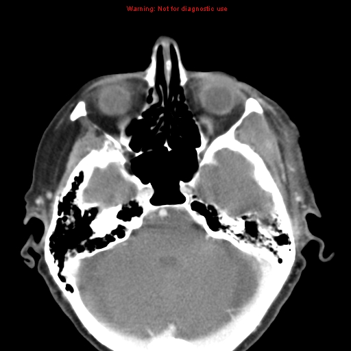 File:Ameloblastoma (Radiopaedia 27437-27631 A 3).jpg