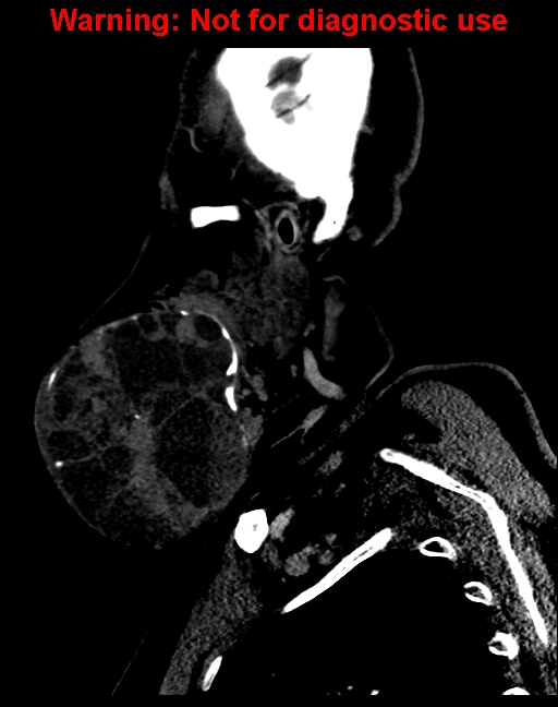 Ameloblastoma (Radiopaedia 33126-34164 F 14).jpg