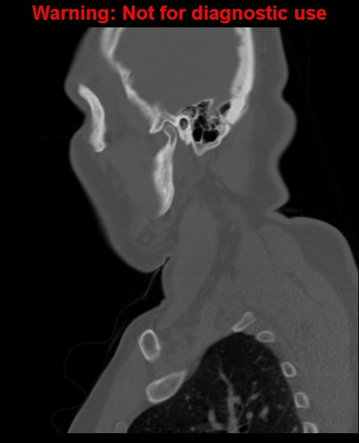 Ameloblastoma (Radiopaedia 33126-34164 Sagittal bone window 58).jpg