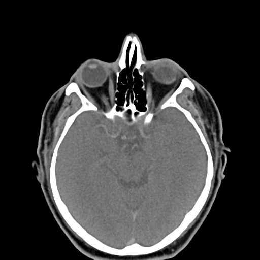 File:Ameloblastoma (Radiopaedia 38520-40623 Axial non-contrast 4).png