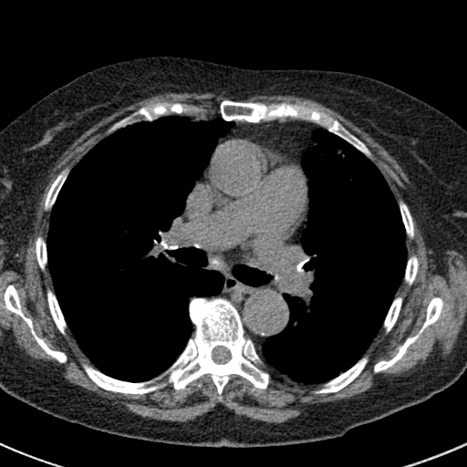 File:Amiodarone-induced pulmonary fibrosis (Radiopaedia 82355-96460 Axial non-contrast 29).jpg