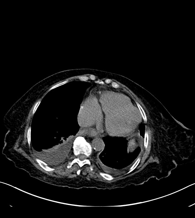 Amiodarone deposition in the liver (Radiopaedia 77587-89780 Axial non-contrast 61).jpg