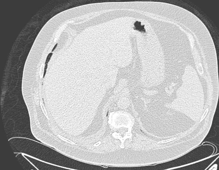 File:Amiodarone lung (Radiopaedia 62514-70769 Axial lung window 81).jpg