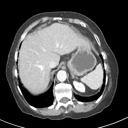 Ampullary adenocarcinoma (Radiopaedia 34013-35237 C 7).png