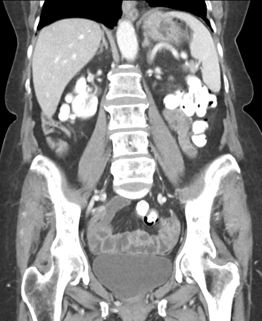Ampullary adenocarcinoma (Radiopaedia 34013-35237 E 31).png