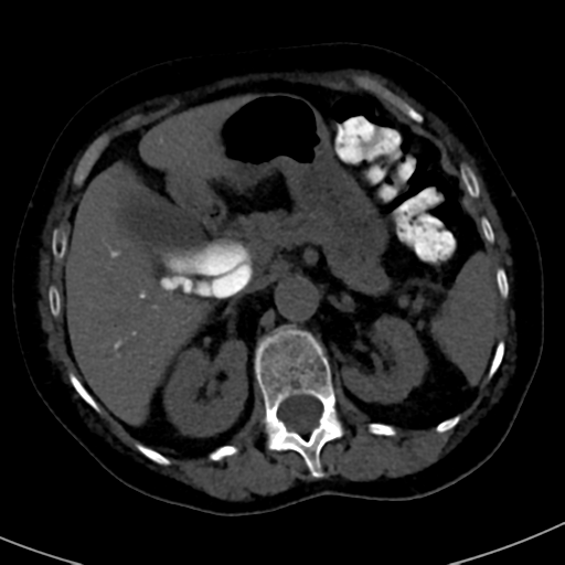 File:Ampullary adenocarcinoma (Radiopaedia 34013-35241 AXIAL THICK 27).png