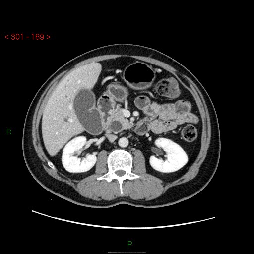 File:Ampullary carcinoma (Radiopaedia 56396-63056 C 40).jpg