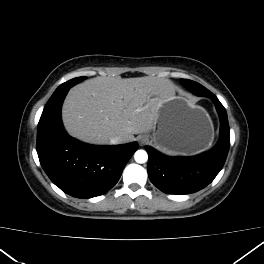Ampullary tumor (Radiopaedia 22787-22816 B 10).jpg