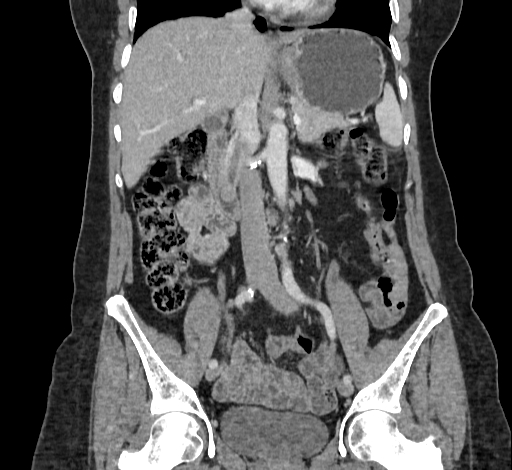 Ampullary tumor (Radiopaedia 60333-67998 B 39).jpg