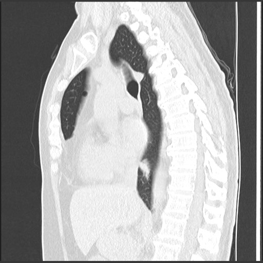 Amyloidosis - bronchial and diffuse nodular pulmonary involvement (Radiopaedia 60156-67744 F 27).jpg