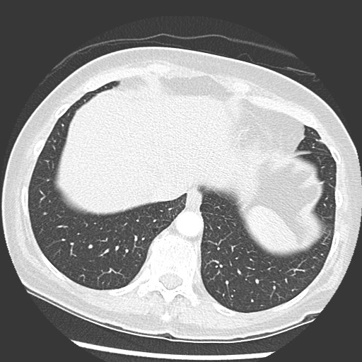 Amyloidosis - bronchial and diffuse nodular pulmonary involvement (Radiopaedia 60156-67745 Axial lung window 70).jpg