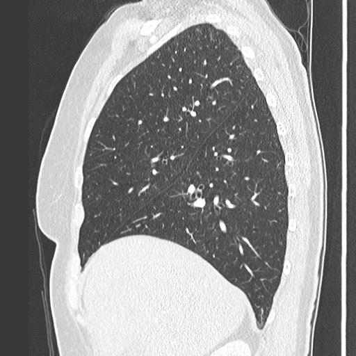 Amyloidosis - bronchial and diffuse nodular pulmonary involvement (Radiopaedia 60156-67745 Sagittal lung window 26).jpg