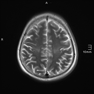 File:Amyotrophic lateral sclerosis (Radiopaedia 70821-81017 Axial T2 19).jpg